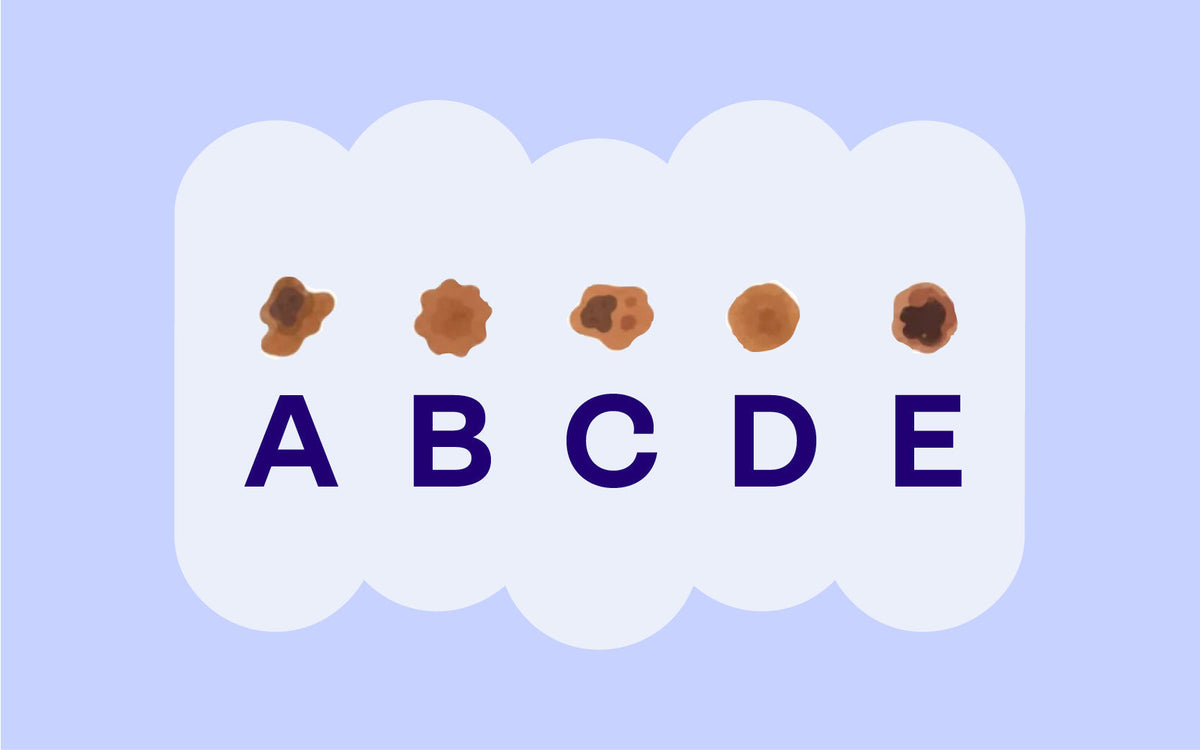 ABCDE-Regel: fünf Muttermale mit den Buchstaben A bis E.