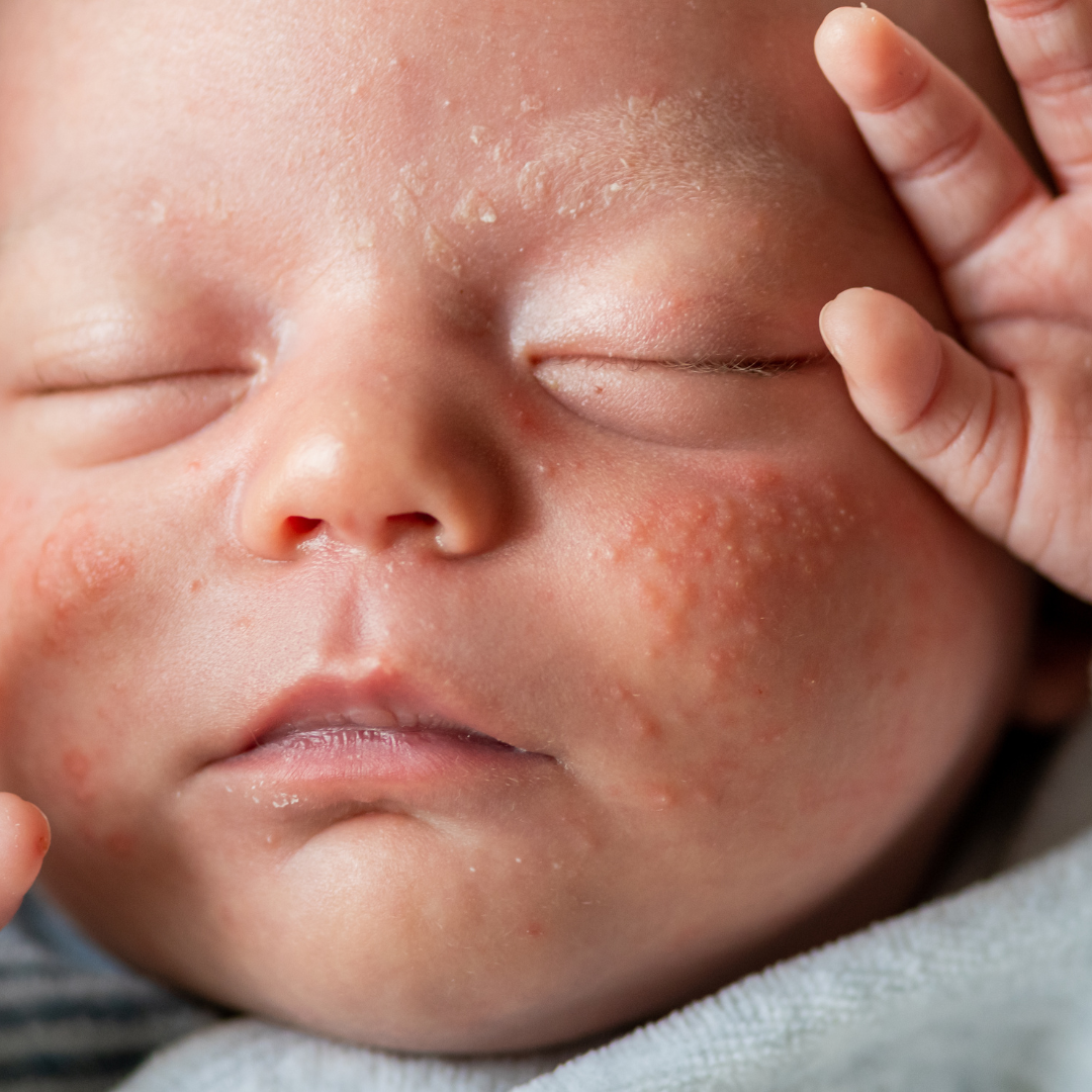 Pickelchen bei Babys